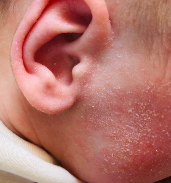 Аллергия у новорожденных: симптомы, лечение и советы